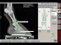  metrondvm  gnration automatique de rapports de radios orthopdiques quines