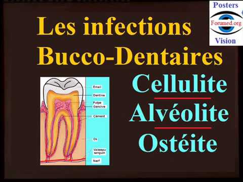 Dental Buccal Infections: Cellulitis Alveolitis Osteitis