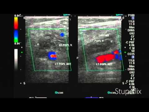 blood clot in leg ultrasound