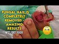 Watch as Fungal Nail is Completely Removed - Amazing Results Miss foot fixer
