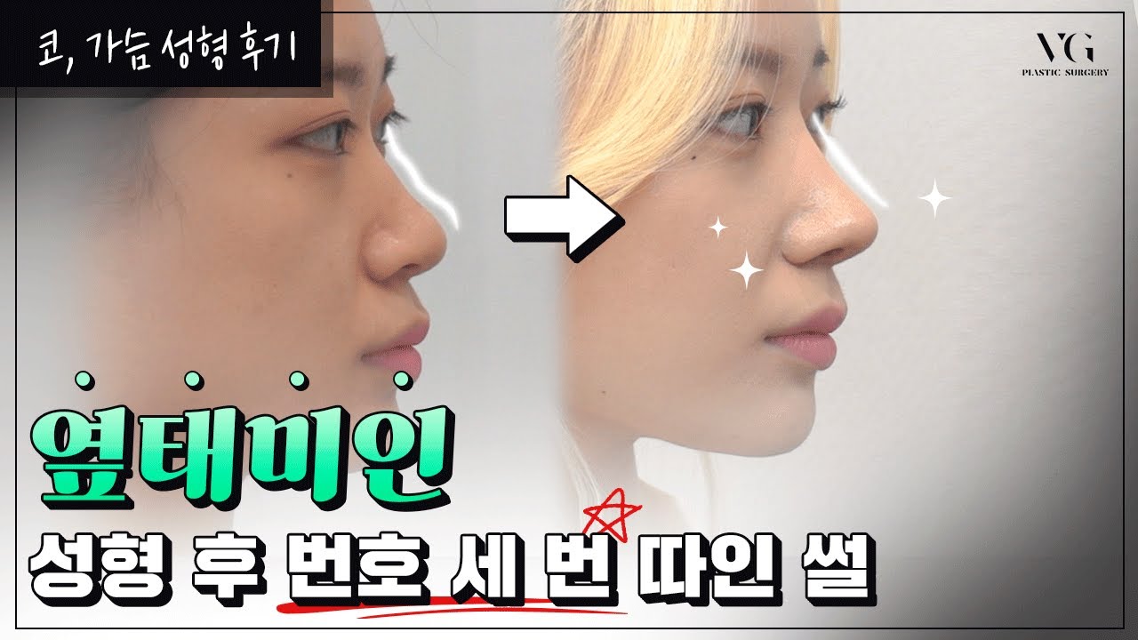 [Вэригүүд гоо сайхны мэс заслын клиник] Хамрын мэс заслын дараа дугаар асуусан түүх ✨ | Хамрын мэс засал хийлгээд 2 сар болсны дараах бодит сэтгэгдэл