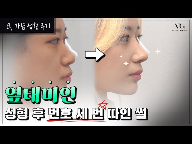 코 성형 후 번호 따인 썰✨| 코 수술 2개월 차  찐후기