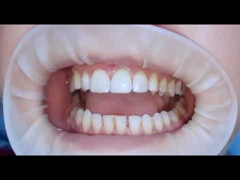 غلق الفراغات بدون تقويم نهائيا فزيارة