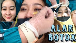 PROCEDURE FOR ALAR BOTOX (SEE THE RESULT)