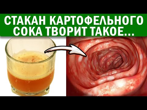 1 ст. сока картофеля возрождает здоровье кишечника, если добавить его в... (НЯК - язвенный колит)