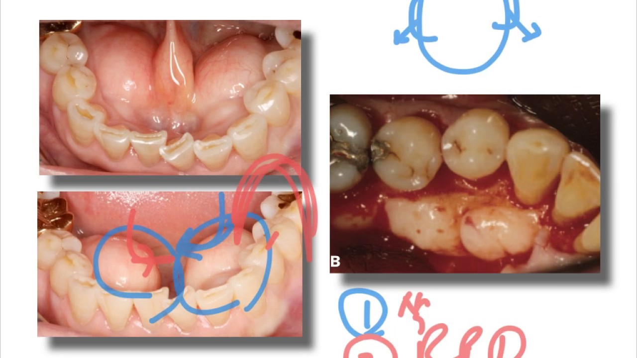 본2 2학기 33장 삭제형 수술 resective periodontal surgery YouTube
