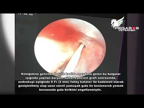 Özofagus (Yemek Borusu) Darlık Tedavisi (Esophageal Stricture)