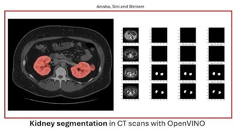 Kidney segmentation in CT Scans with OpenVINO