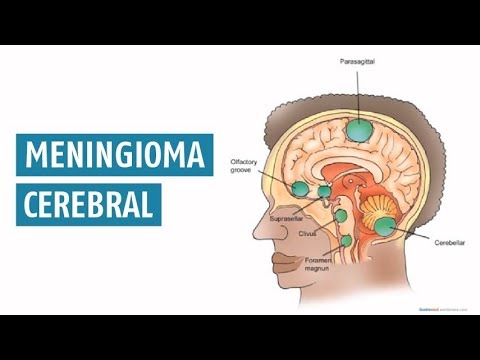 Vídeo: Meningioma Cerebral: Tratamento, Cirurgia, Prognóstico, Causas