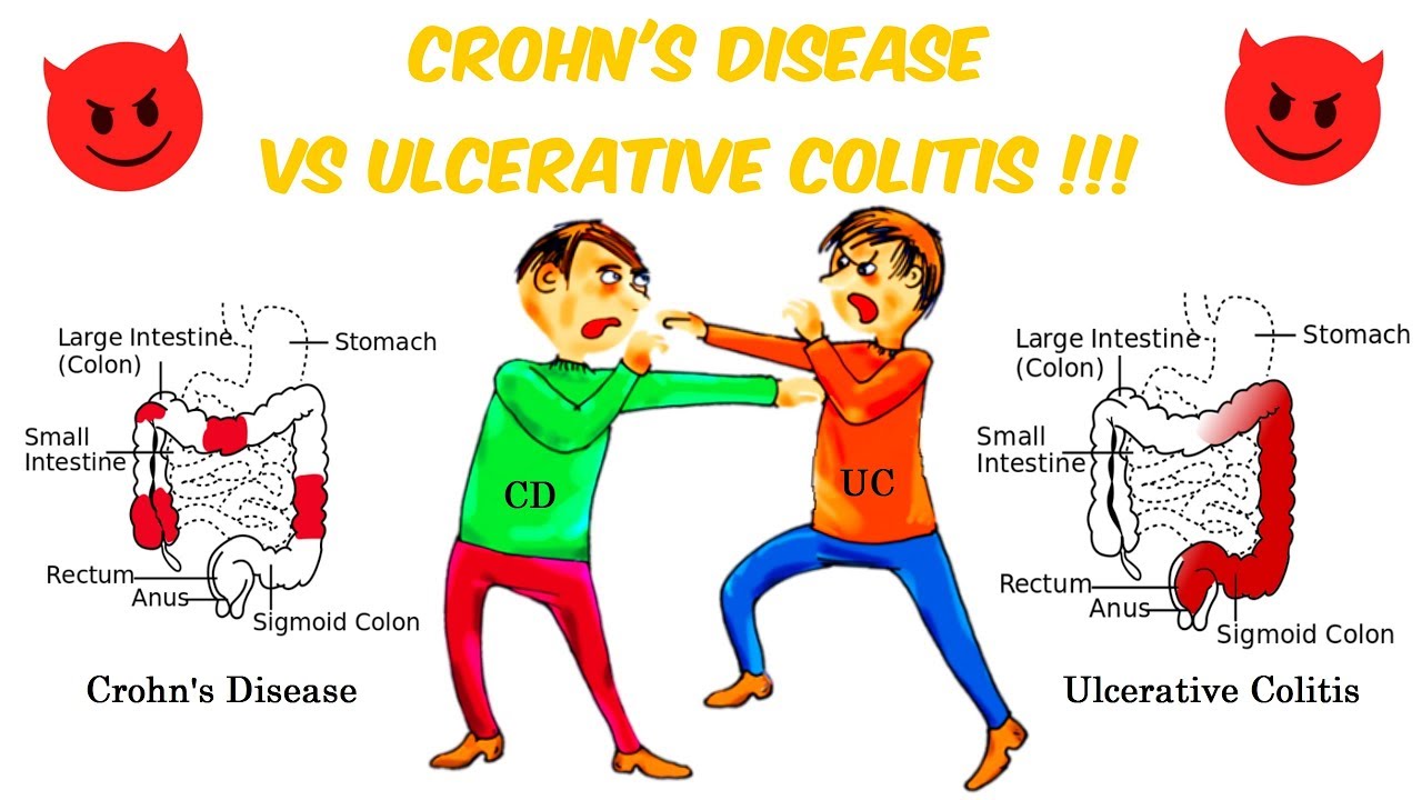 Ulcerative Colitis Vs Crohn S Disease Chart