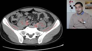 Appendicitis on CT scan | Radiology cases | التهاب الزائدة الدودية على الطبقي | حالات سريرية الأشعة