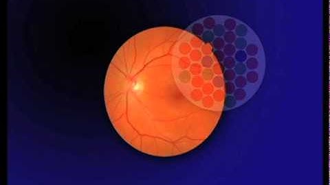 Color Vision Loss. - The 15 Visual Problems of Macular Degeneration