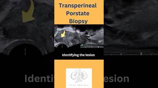 Transperineal Prostate Biopsy Explained!