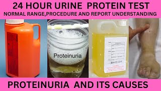 24 HOUR PROTEIN  TESTIN URINE.NORMAL RANGE,PROCEDURE AND REPORT.24 HOUR URINE PROTEIN COLLECTION.