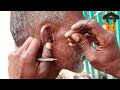 ►I&#39;m Relaxed after Removing Chunky Wax II Earwax Removal in Traditional Way