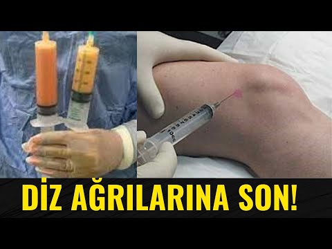 Video: Diz sınığı ilə yeriyə bilərdinizmi?