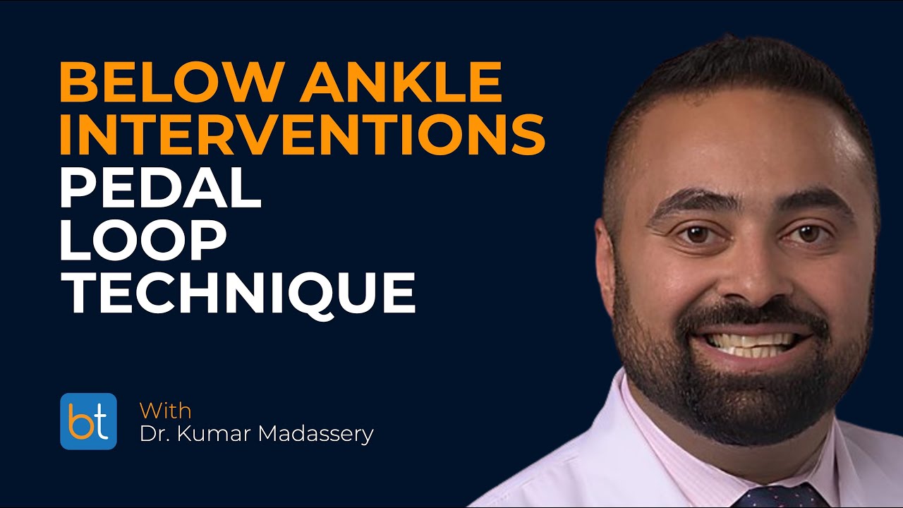 Pedal Loop Technique in Below Ankle Interventions | BackTable Clips