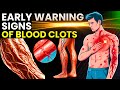 Blood Clot Alert: 10 Warning Signs