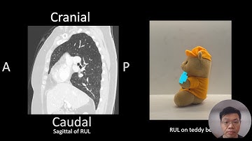 Airway Mapping Made Easy! (Bronchial Branch Tracing) Right Upper Lobe