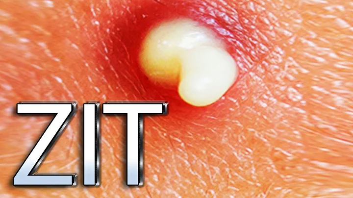 Three Most Surprising Zits and Pimples!