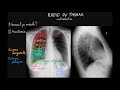 Radio du thorax  introduction  partie 1  docteur synapse