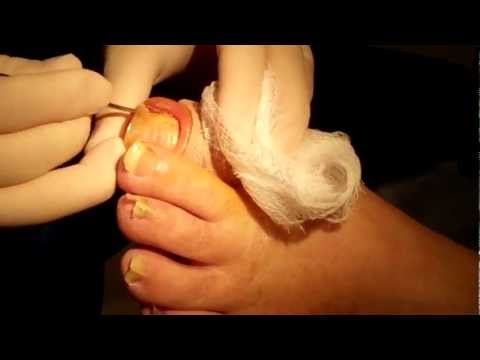 So, what is nail surgery? - Farnham Foot Clinic