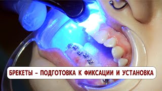 Braces installation and cleaning before braces