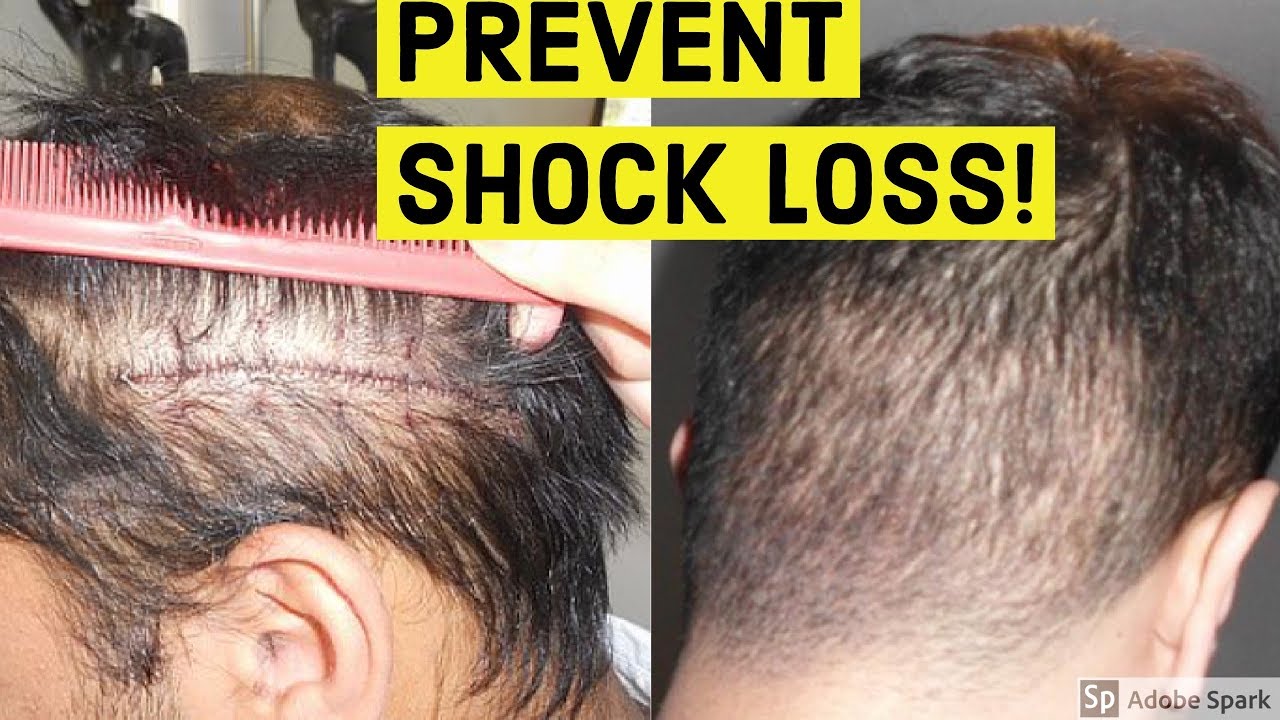 PREVENT SHOCK LOSS AFTER HAIR TRANSPLANT! - YouTube