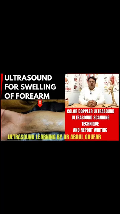 Ultrasound of swelling #mskultrasound #mskimaging #msklearningshorts #ultrasound #video #youtube