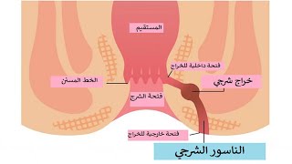 طريقة علاج الناسور الشرجي منزليا فعال جدا