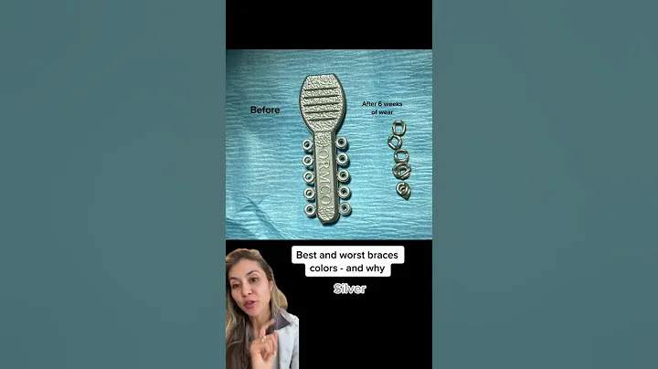 Best/Worst Braces Colors-Silver