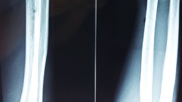 Fracture both the bones forearm type 1 compound treated,  Adamya Hospital videos