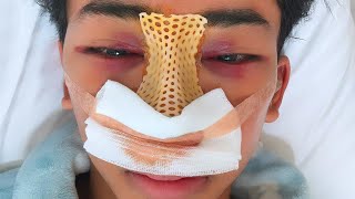 I got a nose job in Korea...