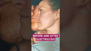 Electrolysis permanent facial hair removal is life changing! PCOS, PMOS, Hirsutism, Unwanted Hair