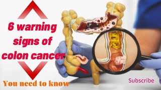 6 warning signs of colon cancer | colon cancer symptoms | colon cancer |