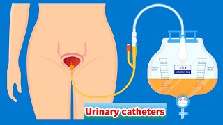 تعلم تركيب القسطرة البولية في3دقائق _ Female Foley Insertion (Urinary Catheter)