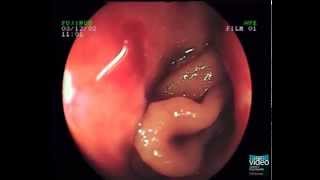 Adenocarcinoma of the Small Bowel