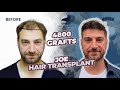 Turning back the clock incredible results of a 4800 graft hair transplant  before and after