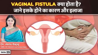 L Fistula कय ह? जन इसक हन क करण, लकषण और उपचर Dr Akta Tata 1Mg