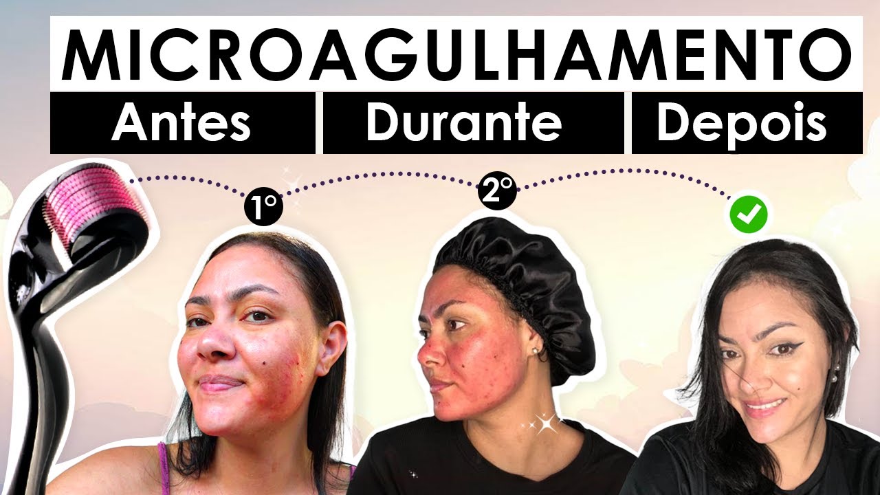 🔞Como fazer MICROAGULHAMENTO em CASA ll Gravei o antes eo resultado ...