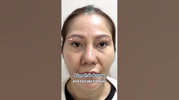 Bác sĩ Tú Dung CẤY MỠ MẶT Việt kiều U50 Đài Loan HẾT HỐC HÁC, GIẬT MÌNH TRẺ 20 TUỔI