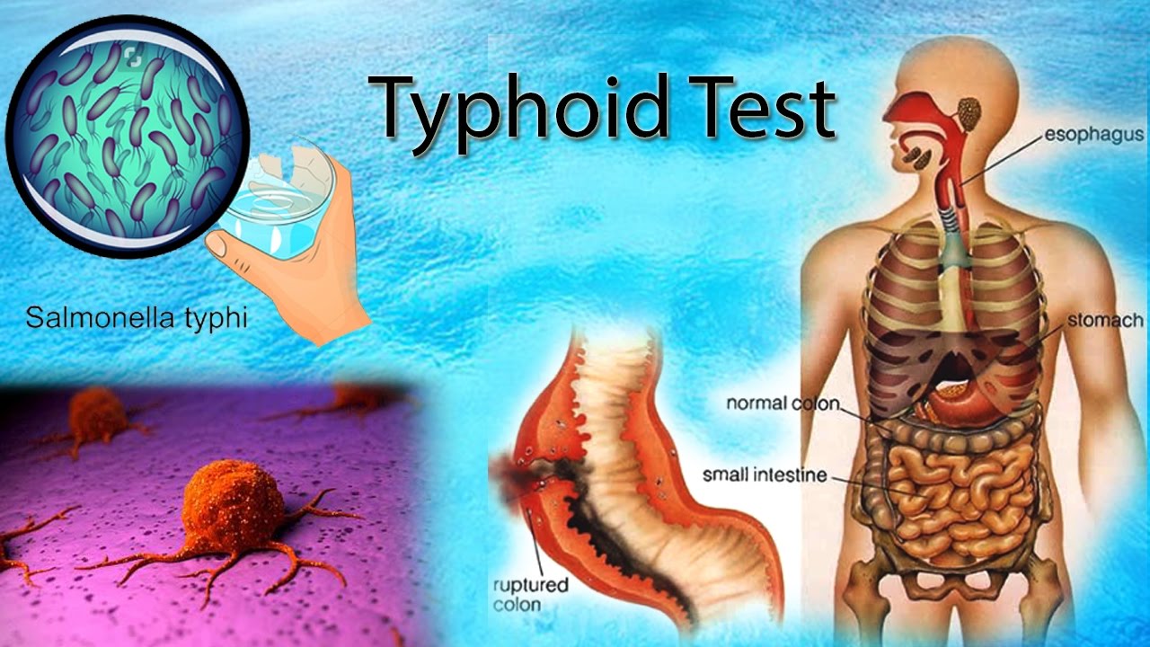 Typhoid Test | Fever temperature|# Blood test | Harib Diagnostic Lab - YouTube