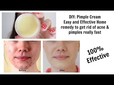 DIY Pimple Cream || % effective acne treatment