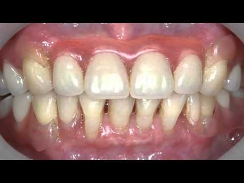 Dis Eti Cekilmesi Ozel Dentilife Agiz Ve Dis Sagligi Polikilinigi