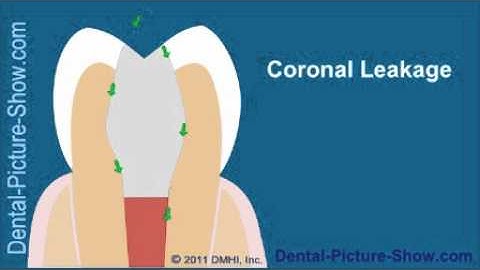 Root canal treatment complications: Coronal Leakage.