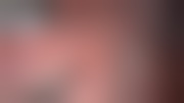 Master Class of Laparoscopic Tumble Square Knot by Dr. R.K. Mishra