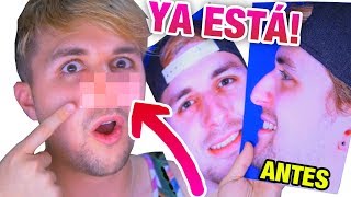 Mi nueva nariz... POR FIN 😱😱😱 (Mi operación de Rinoplastia)