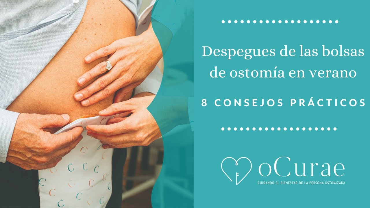 Despegues bolsas de ostomía en verano. 8 CONSEJOS PRÁCTICOS- marzo 2024