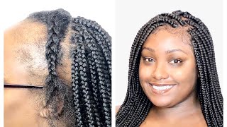 Lace Frontal Box Braids For Thinning Hair - No Wig Needed