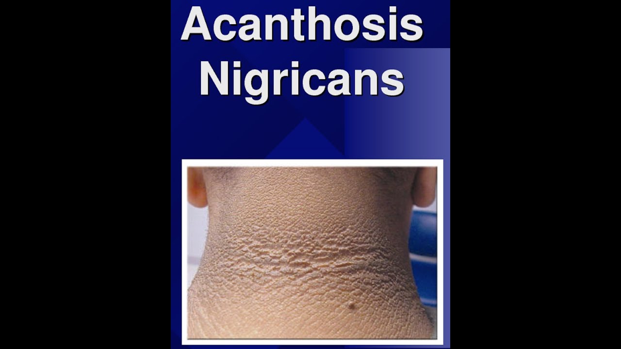 diabetes de acantose nigricans
